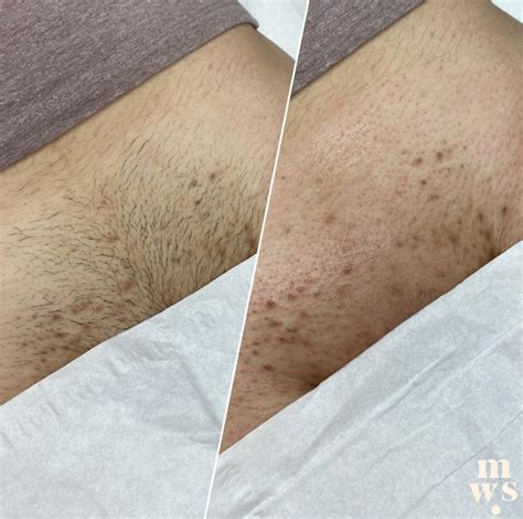 Brazilian Wax Before and After – WAXINGPROS.COM.